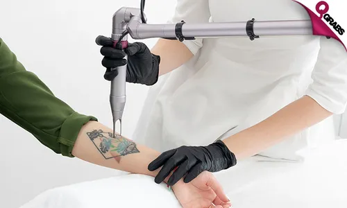 Laser Tattoo Removal!